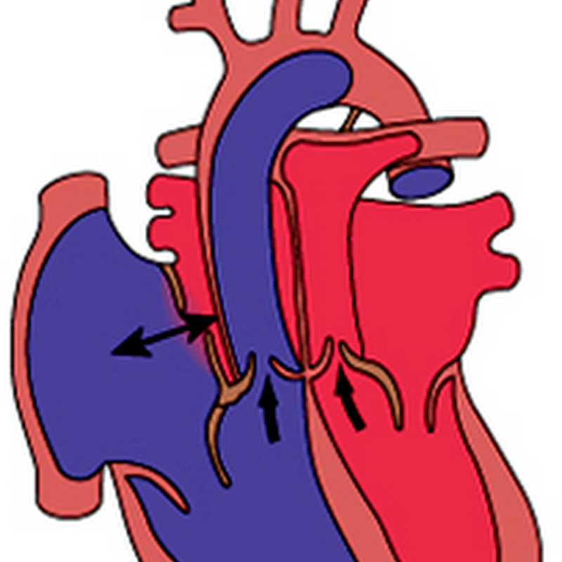 CYANOTIC CONGENITAL HEART DISEASE - Radiology Made Easy